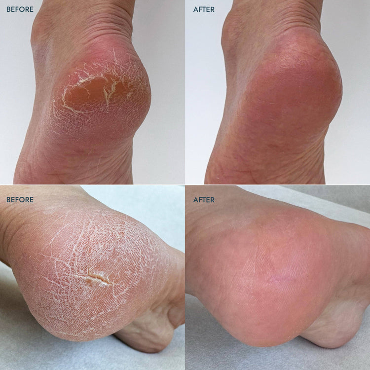 Reusable Heel Repair Duo - Lavender